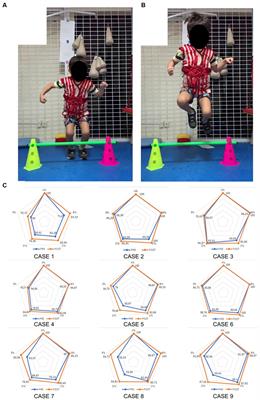 Positive impact of the Therasuit method on gross motor function of children with autism spectrum disorder: Case series